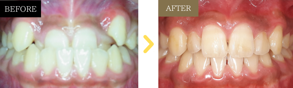 受け口・八重歯の歯列矯正の症例
