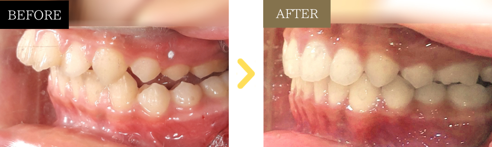 出っ歯の歯列矯正の症例