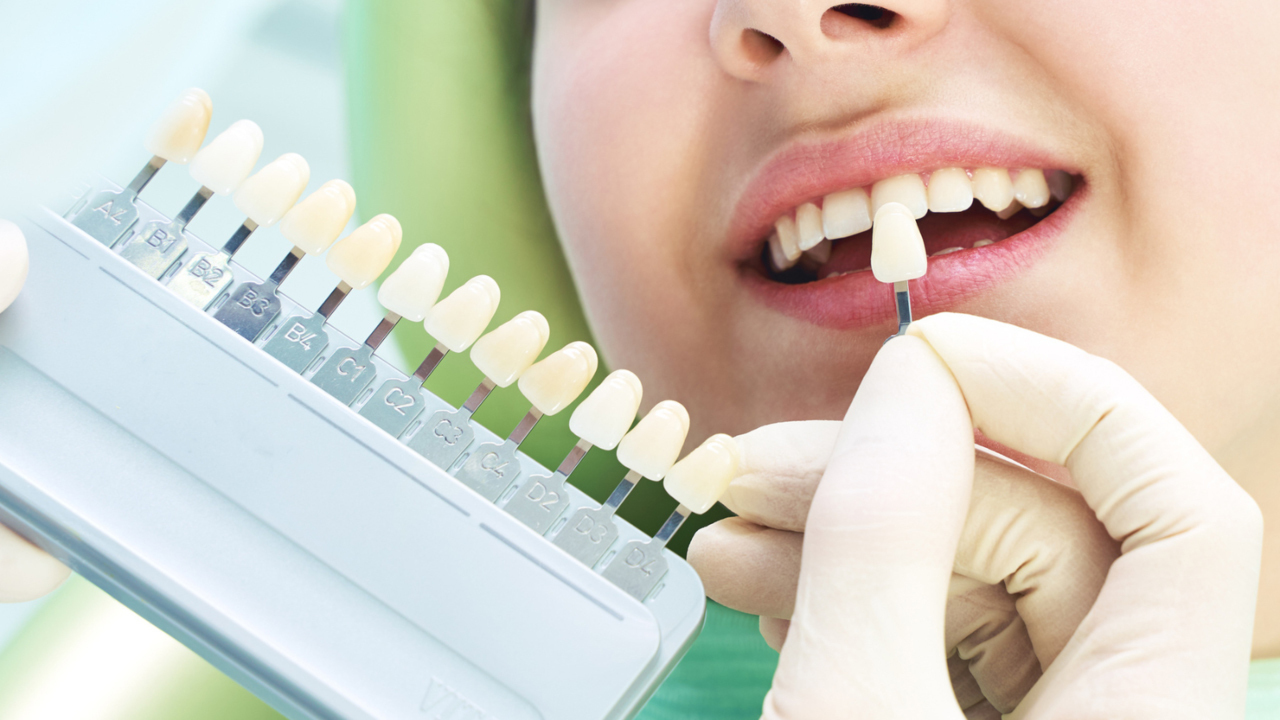 オフィスホワイトニング