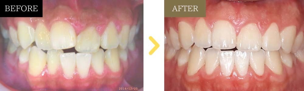 非抜歯で出っ歯とガタガタが治った症例1）