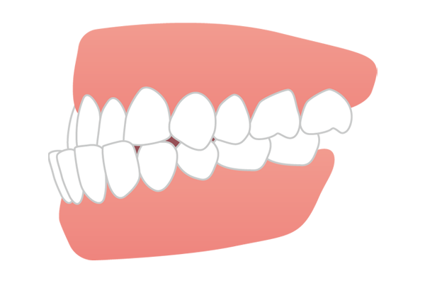 下の歯が上の歯より前に出ている受け口・しゃくれ（反対咬合・下顎前突）のイラスト