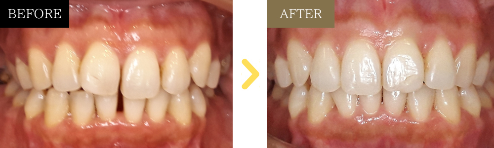 ガタガタ・すきっ歯の治療前後比較写真