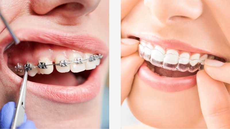 マウスピース矯正は透明で目立たない - 西宮矯正歯科相談室（西宮・西宮市・甲陽園）