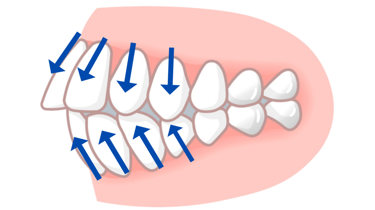 前歯が前方に出っ張るイメージ