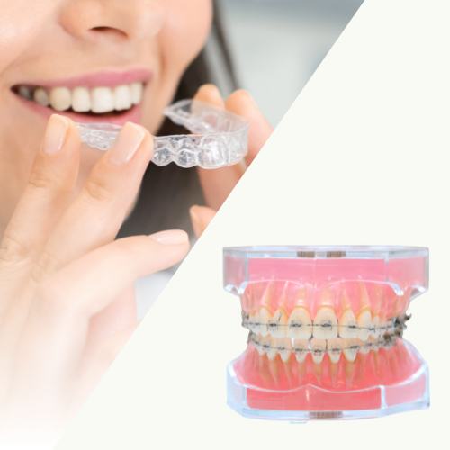 マウスピース矯正は重度の歯並びは適応外 - 西宮矯正歯科相談室（西宮・西宮市・甲陽園）