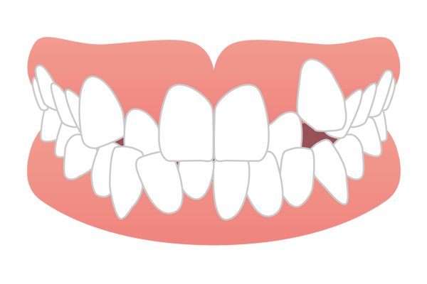 歯が凸凹に重なり合っている叢生・乱杭歯（ガチャ歯）のイラスト