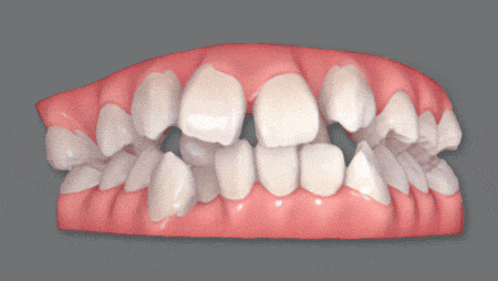 矯正前後の歯並びの変化がわかるシミュレーション画像