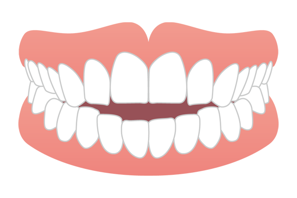 前歯が噛み合わず隙間がある開咬（オープンバイト）のイラスト