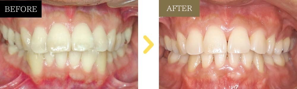 出っ歯と歯並びの乱れが治った症例