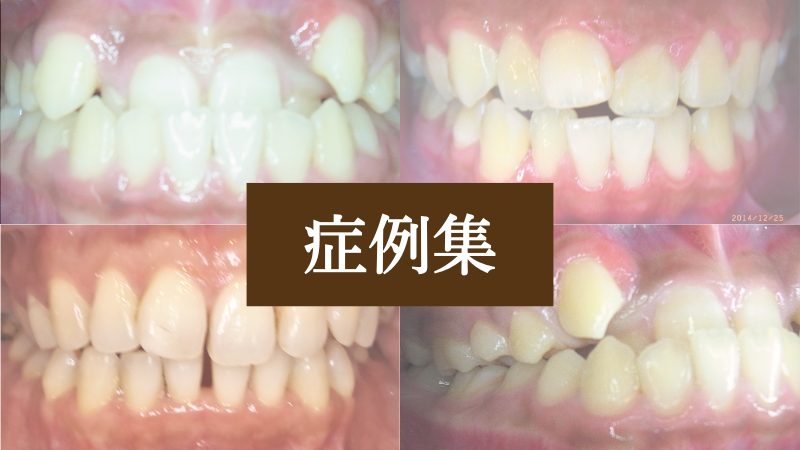 様々な歯並びの症例