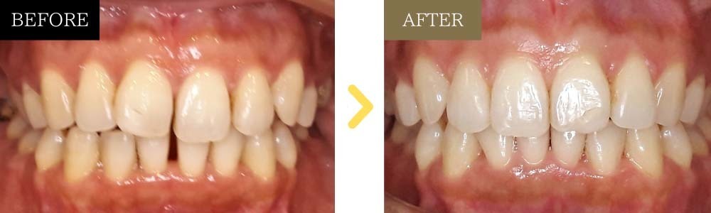 非抜歯でガタガタとすきっ歯が治った症例40代