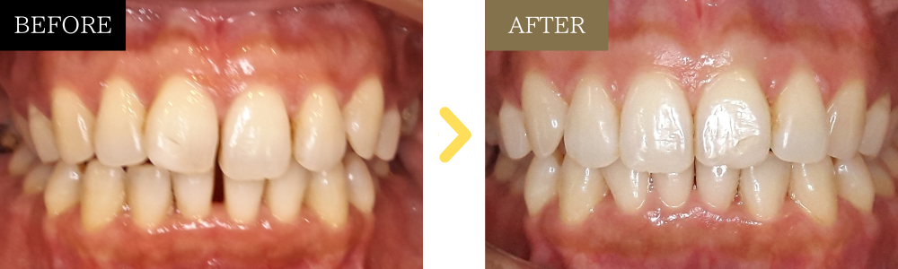 ガタガタ・すきっ歯の歯列矯正の症例