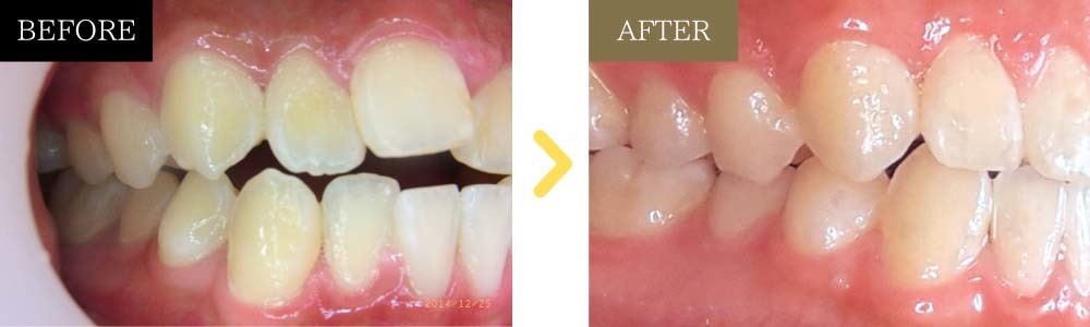 非抜歯で出っ歯とガタガタが治った症例2）