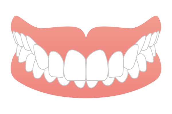 下の歯がほとんど見えない過蓋咬合（ディープバイト）のイラスト