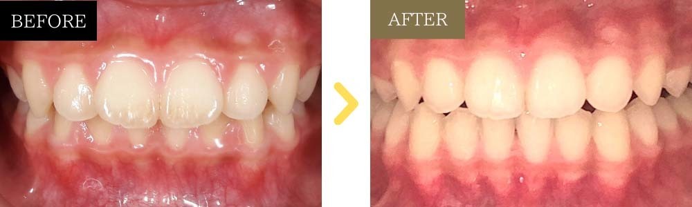 非抜歯で出っ歯が治った症例