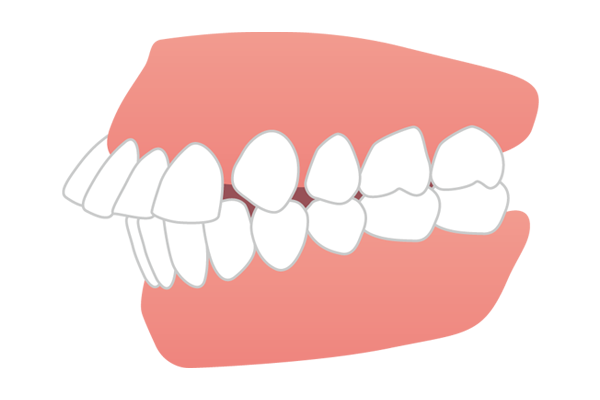 上の前歯が大きく前に出ている出っ歯（上顎前突）のイラスト