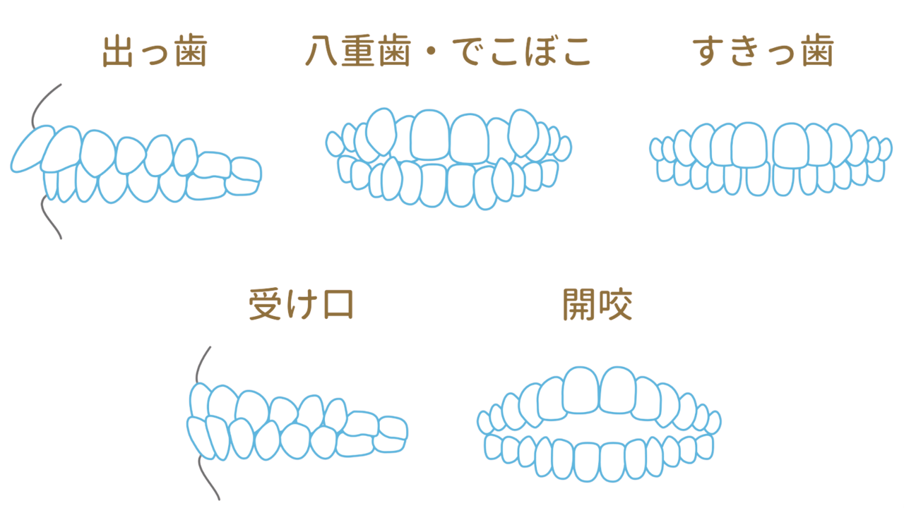 他院で断られた方もおまかせ - 西宮矯正歯科相談室（西宮・西宮市・甲陽園）