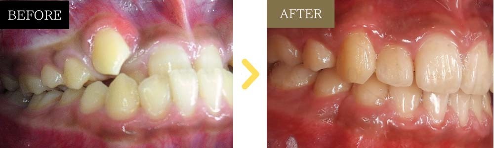 受け口と八重歯が治った症例10代