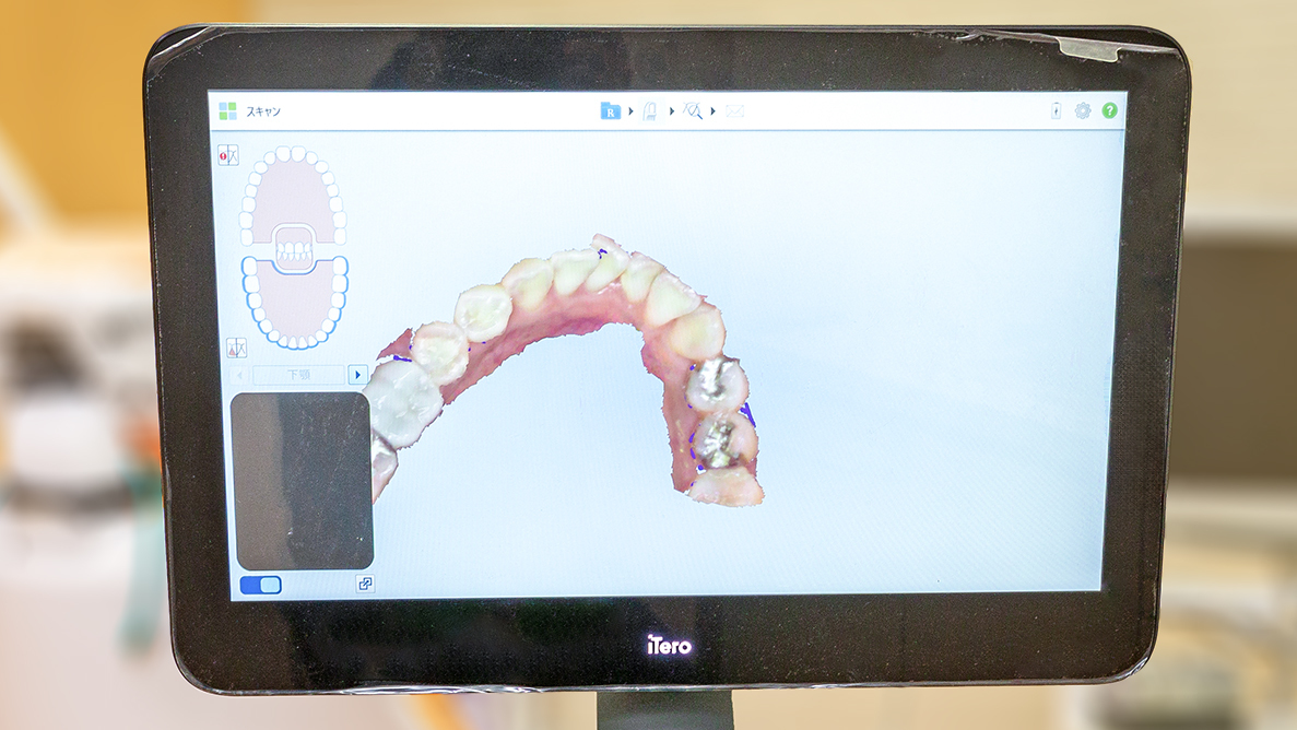 iTeroスキャナーで精密な口腔内データを取得する様子