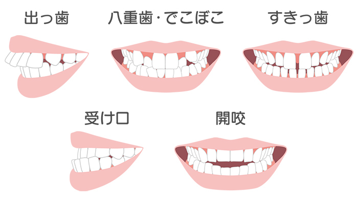 あなたの歯並びもきっとキレイに軽い症状・重い症状まとめてお任せ