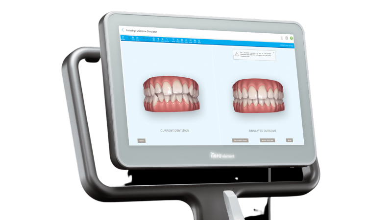 AIによる矯正のシミュレーション