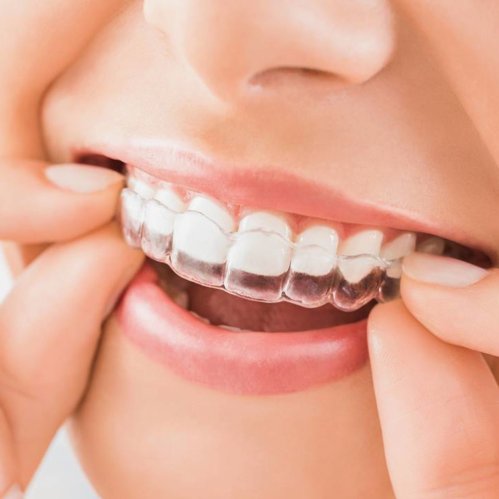マウスピース矯正とは - 西宮矯正歯科相談室（西宮・西宮市・甲陽園）