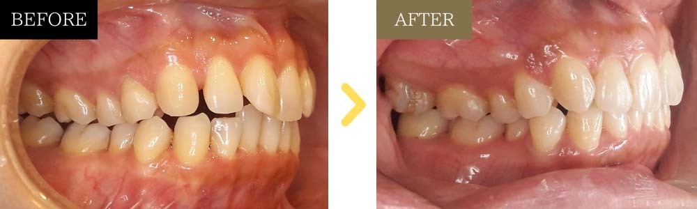 非抜歯でガタガタとすきっ歯が治った症例40代2