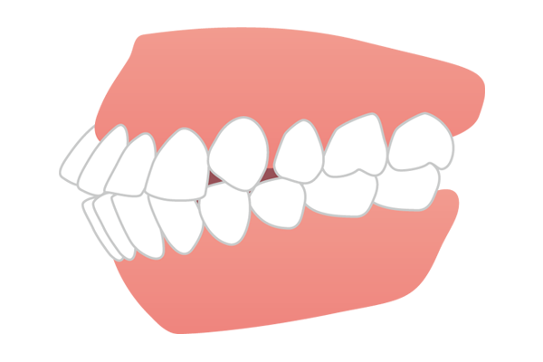 口元全体が前方に突出している口ゴボ（上下顎前突）のイラスト