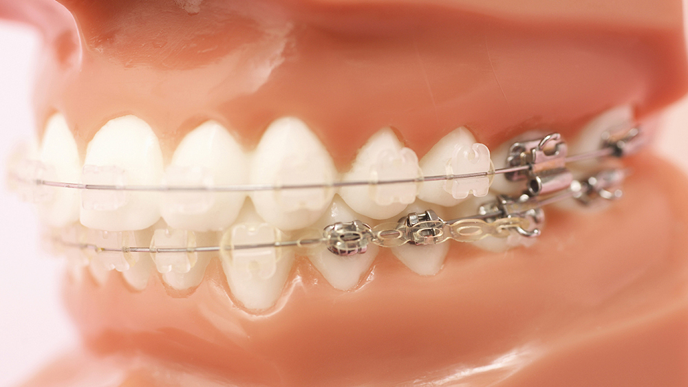 ワイヤー矯正のブラケット装置を装着した歯の模型