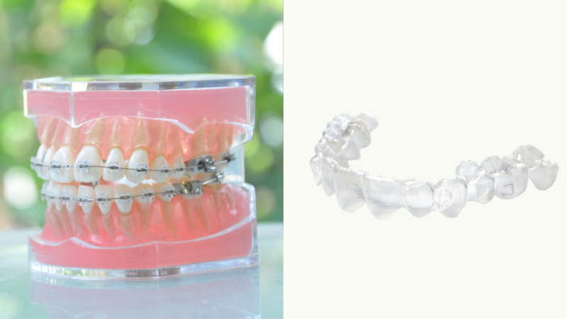 ワイヤー・ブラケットを装着された模型とマウスピース装置の写真