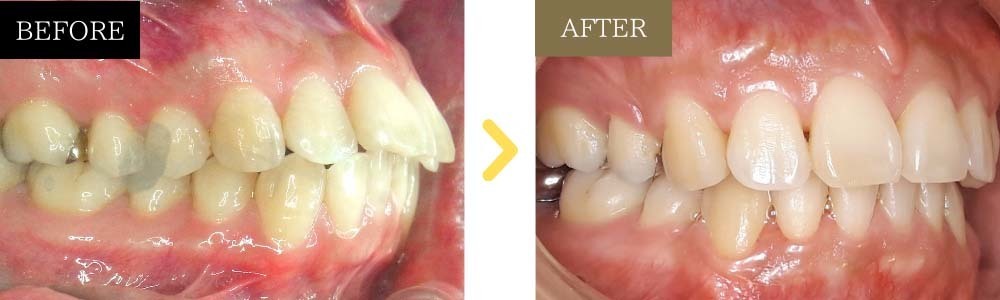出っ歯と歯並びの乱れが治った症例