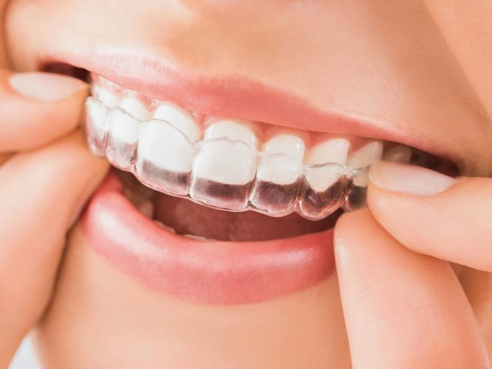 マウスピース矯正 - 西宮矯正歯科相談室（西宮・西宮市・甲陽園）
