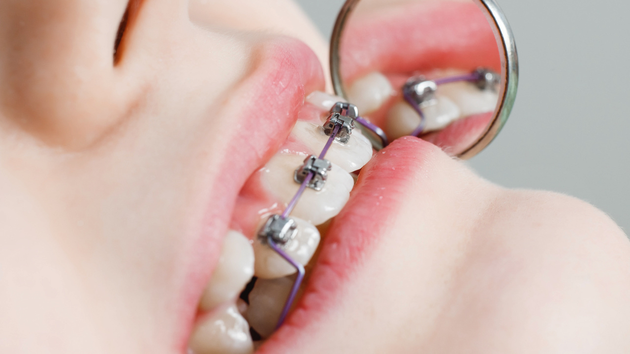 前歯を矯正した女性の口元