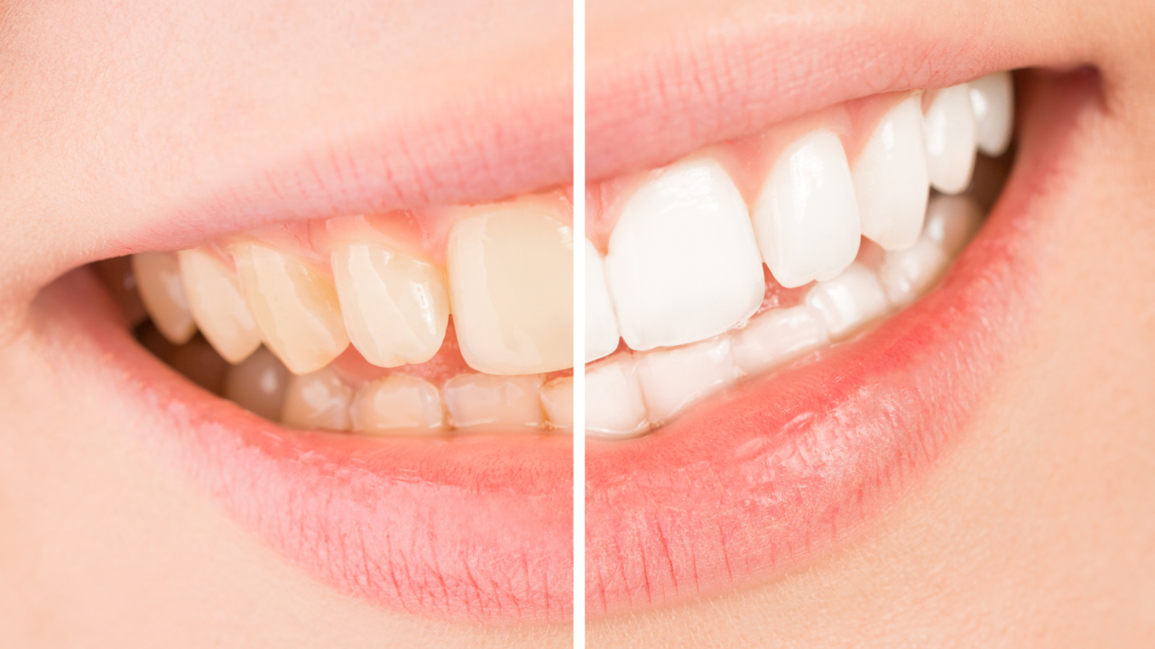 ホワイトニングしていない歯としている歯の比較