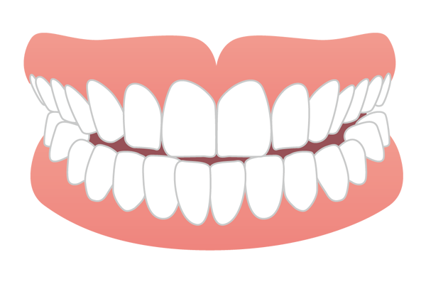 上下の前歯の先端が当たっている切端咬合のイラスト
