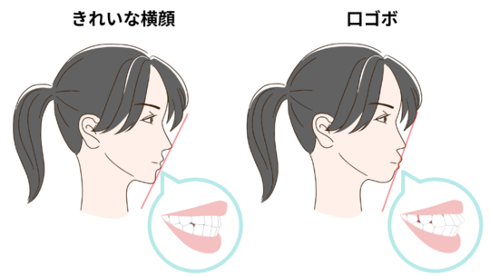 口ゴボ・ゴボ口の矯正 - 西宮市矯正歯科相談室